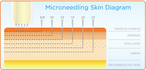 Skin layers showing the depth microneedling goes into the skin