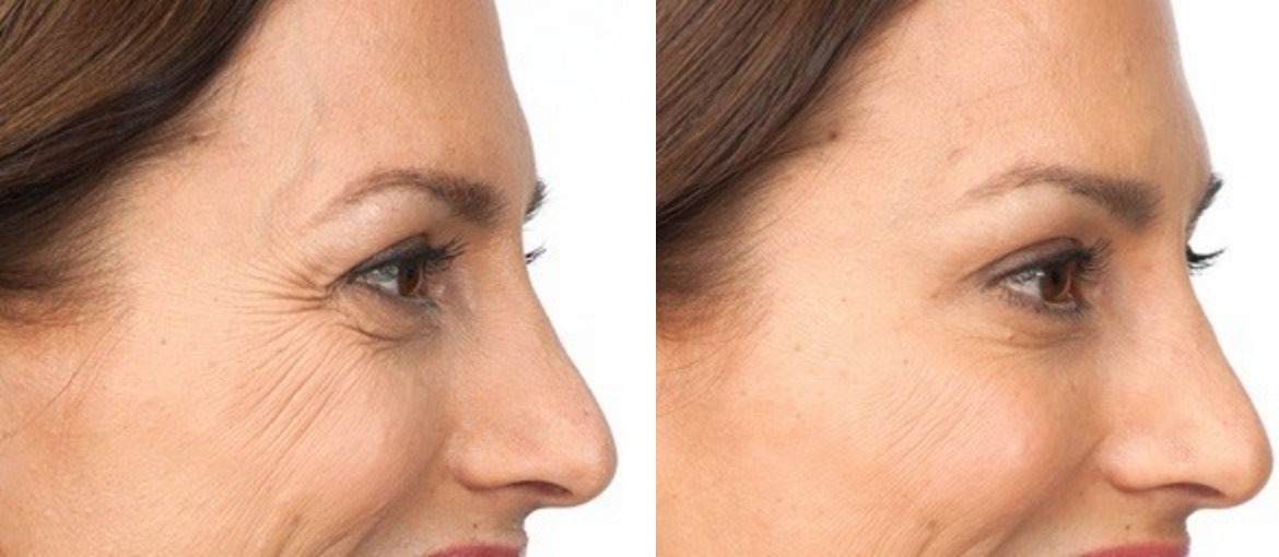 botox: before and after (side)