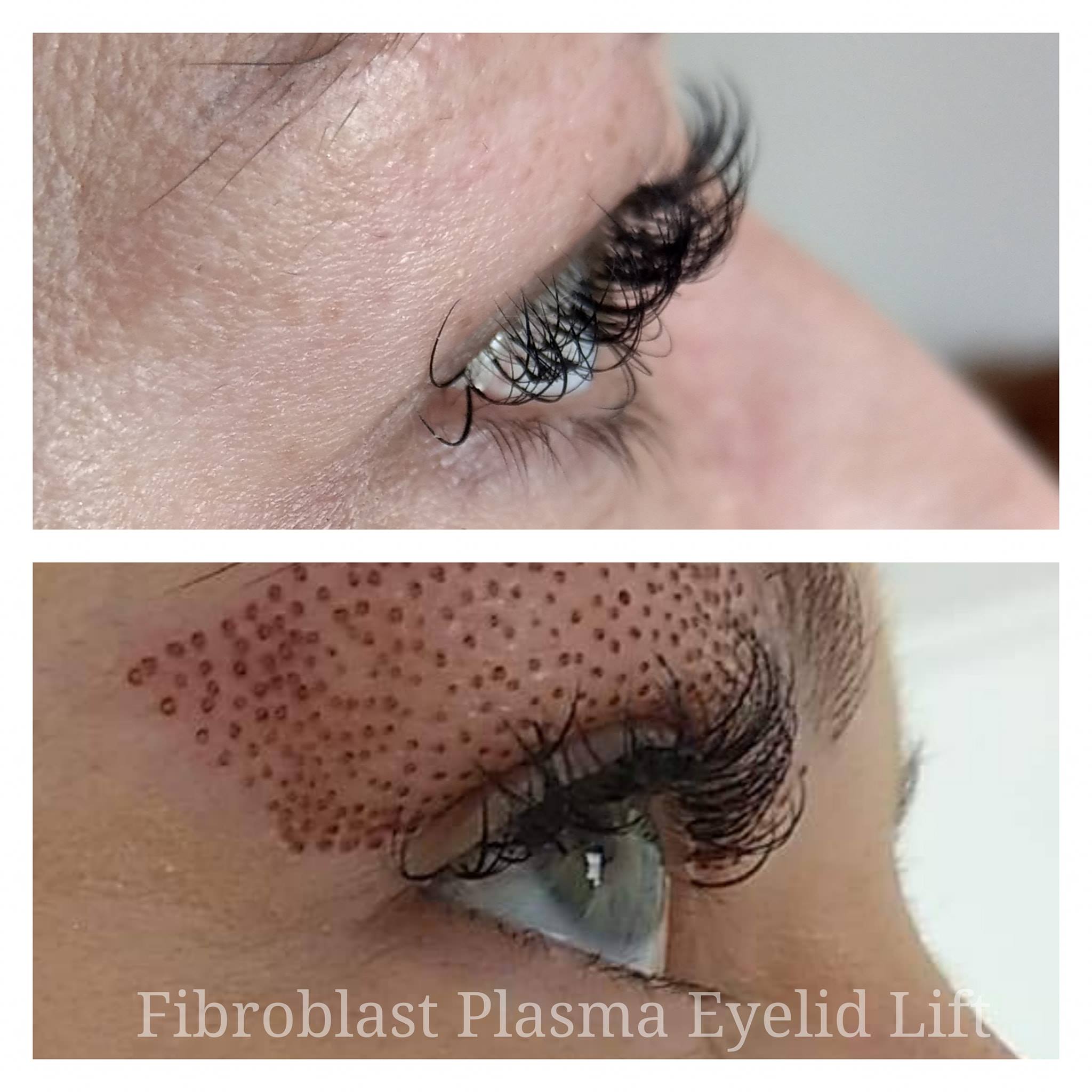 Before and after Fibroblast Plasma Eyelid Lift