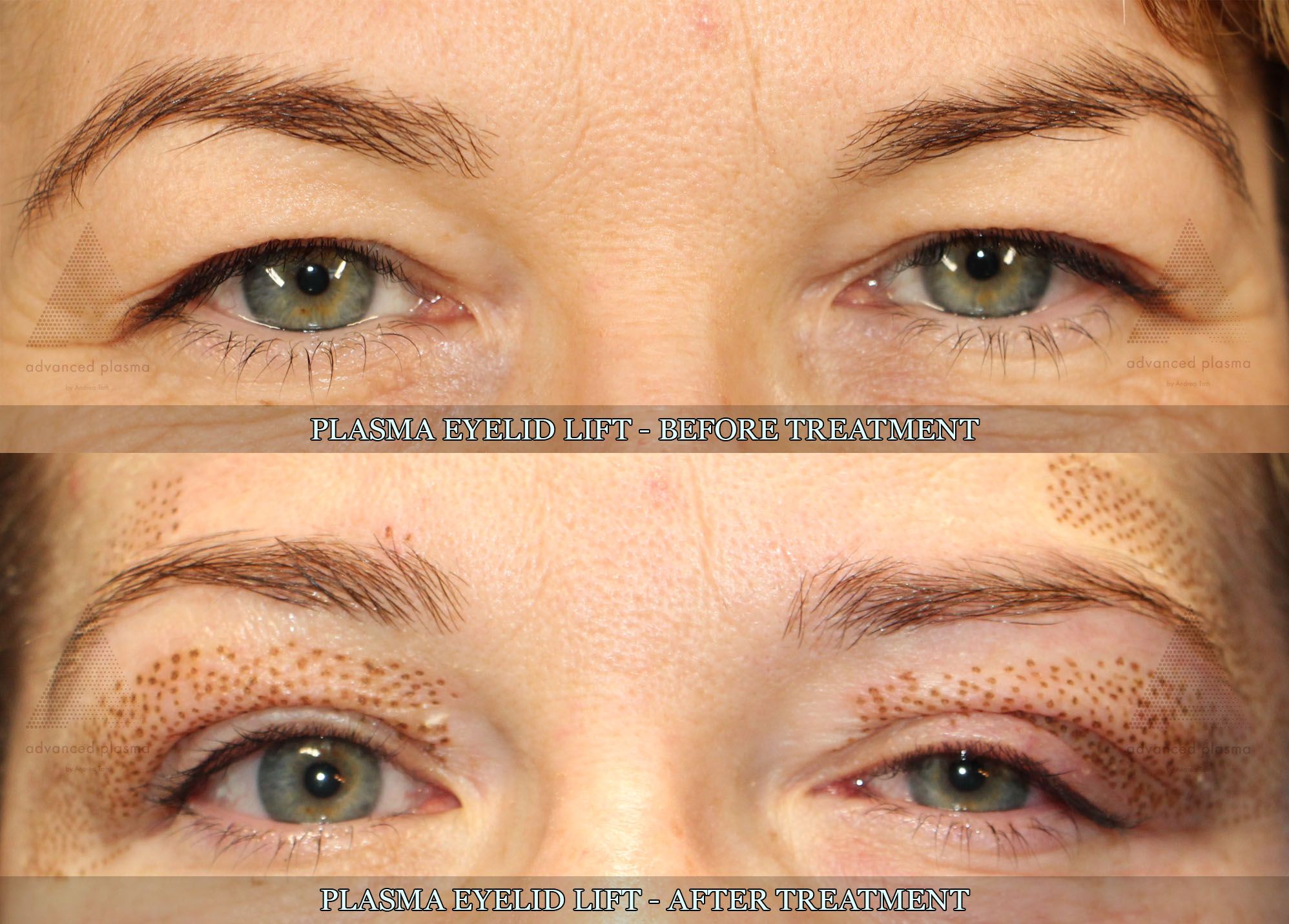 Before and after Plasma Eyelid Lift