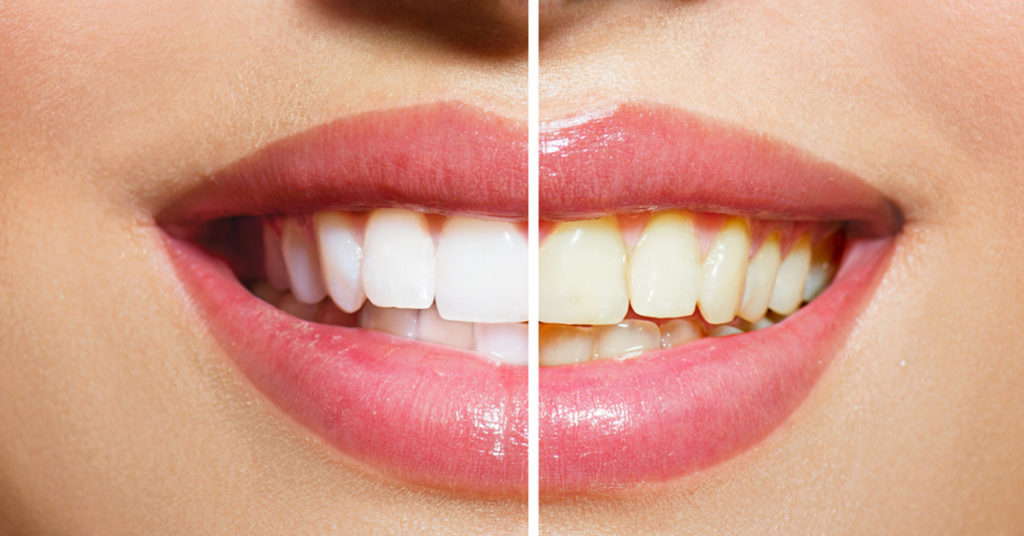 before and after teeth whitening