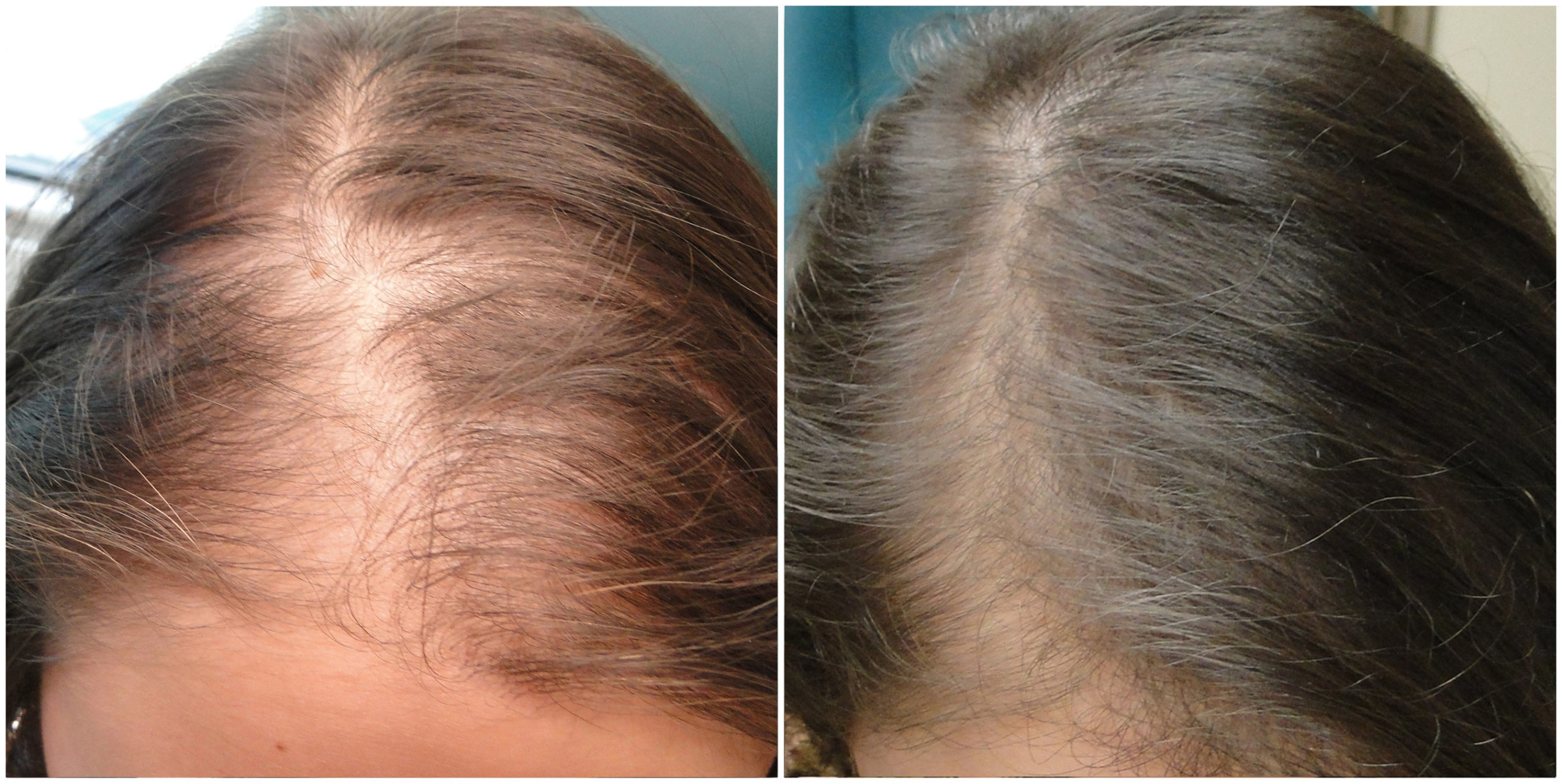 Platelet Rich Plasma Therapy for Hair - Beauty Lounge in San Marcos, CA