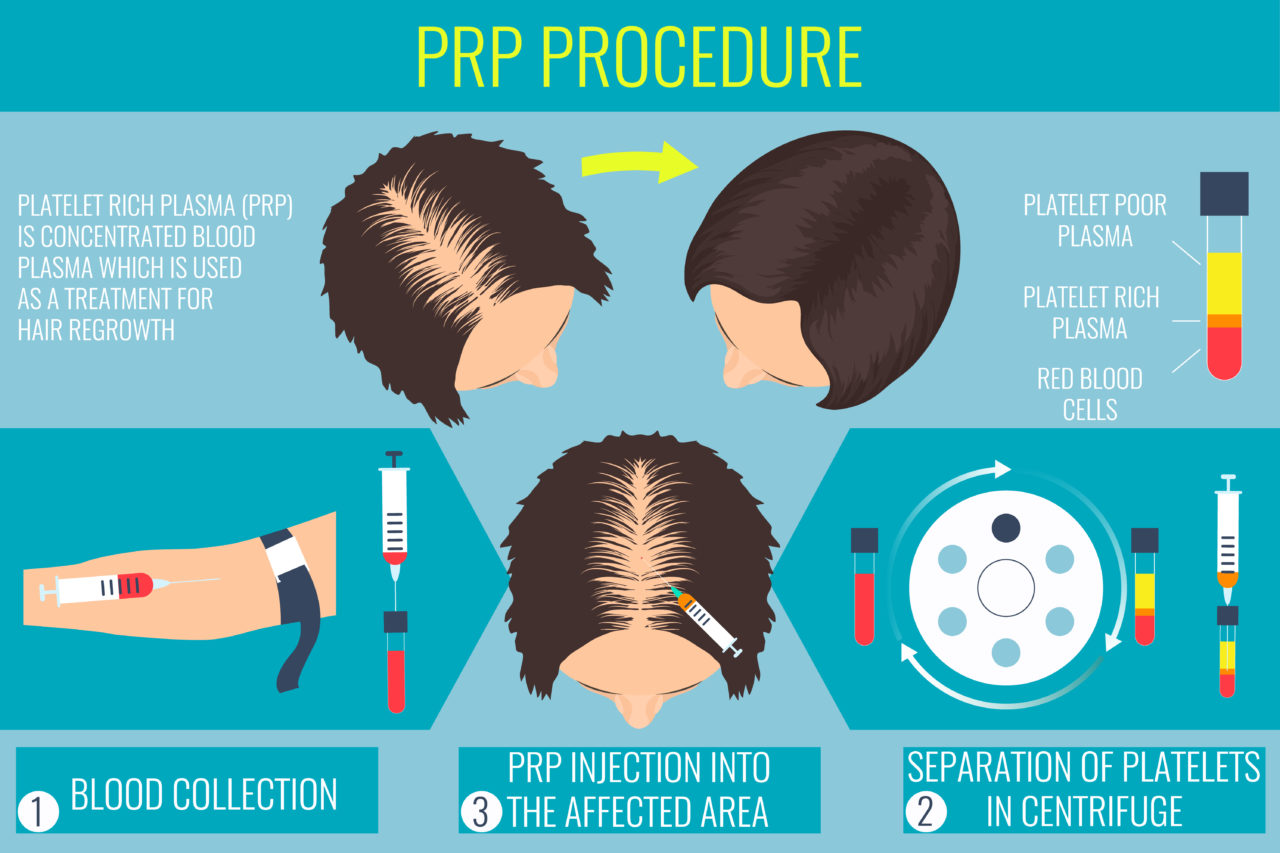 Platelet rich plasma injection. PRP therapy process. Male hair loss treatment infographics. Injection. Meso therapy. Hair growth stimulation.