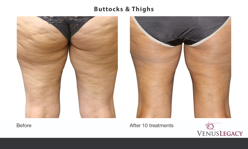 Cellulite Treatment - Body Contouring