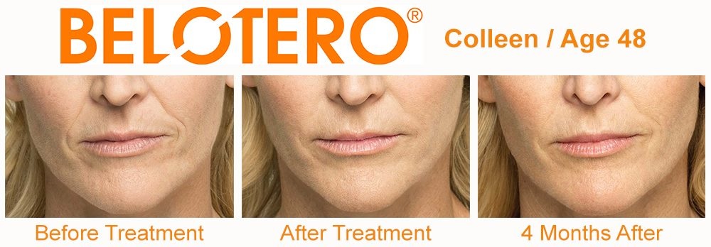 Belotero-Before-and-After-in-Houston-Skin-101