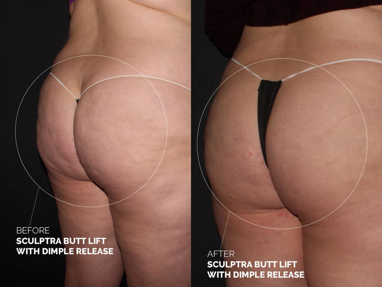 sculptra-butt-lift-dimple-release-before-after