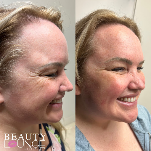 botox for crow's feet before and after photos