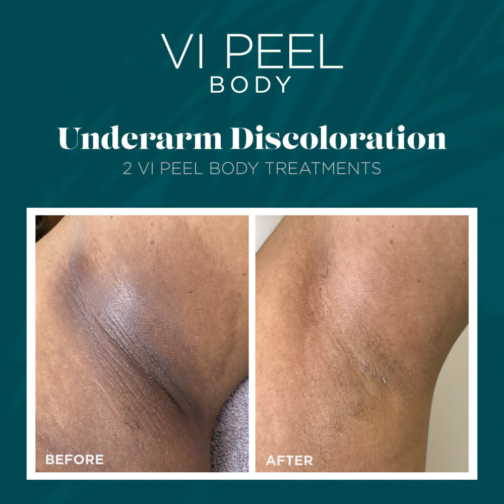 vi peel body, skin lightening, intimate lightening