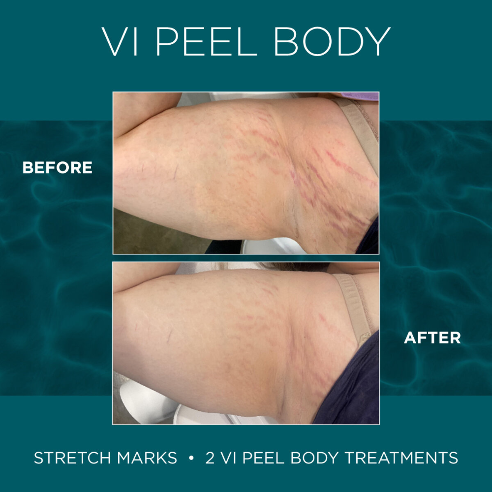 vi peel body, skin lightening, intimate lightening