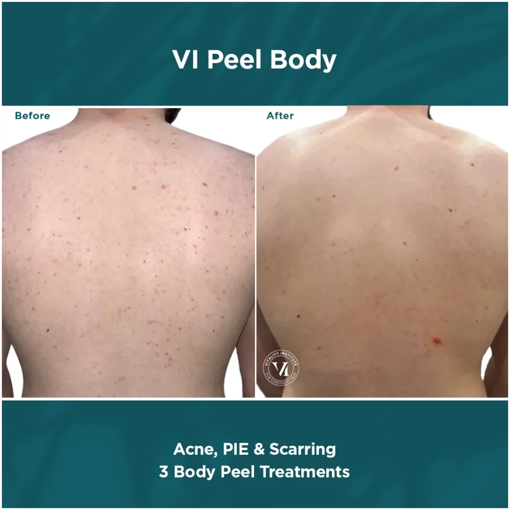 vi peel body, skin lightening, intimate lightening