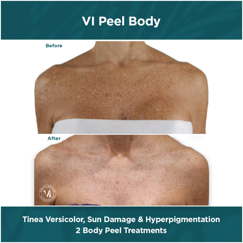 vi peel body, skin lightening, intimate lightening