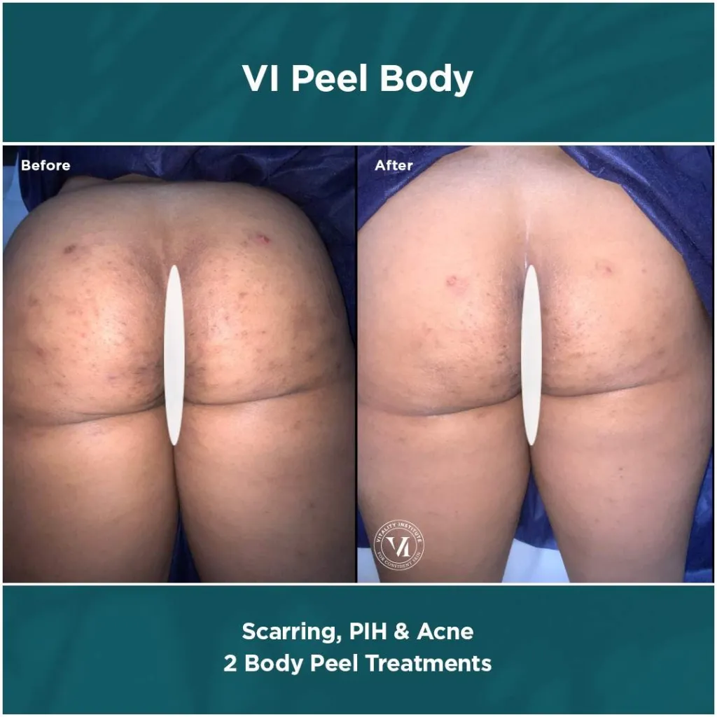 vi peel body, skin lightening, intimate lightening