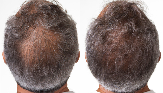 PRP or PRF Hair Restoration ~ 1