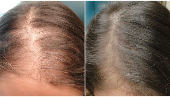 PRP or PRF Hair Restoration ~ 2