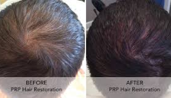 PRP or PRF Hair Restoration ~ 3