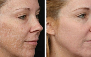 hyperpigmentation-before-after-venus-versa-boca