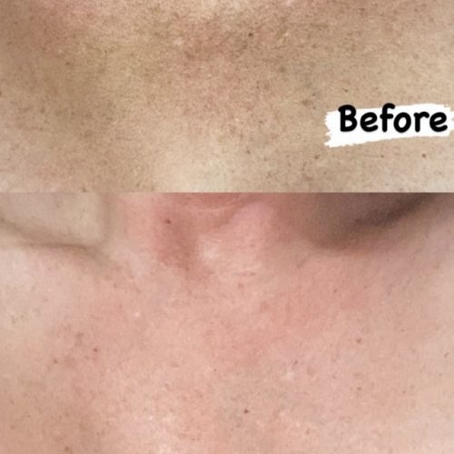 Chest Skin Rejuvenation Treatment, San Diego, CA